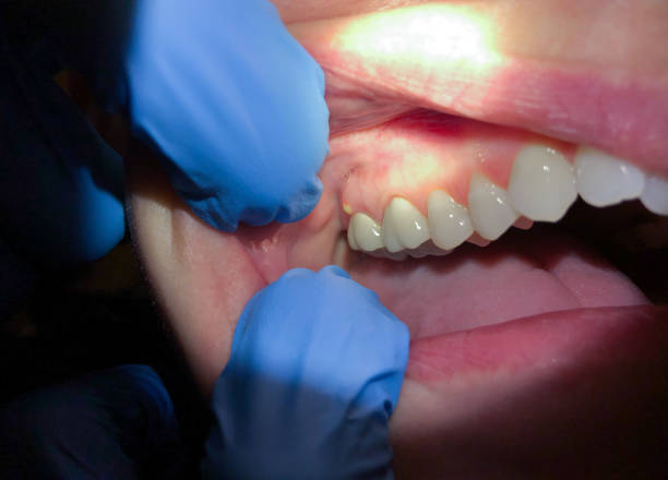 Best Emergency Gum Treatment in Woodworth, OH
