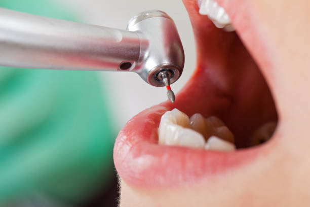 Best Emergency Wisdom Teeth Removal in Woodworth, OH